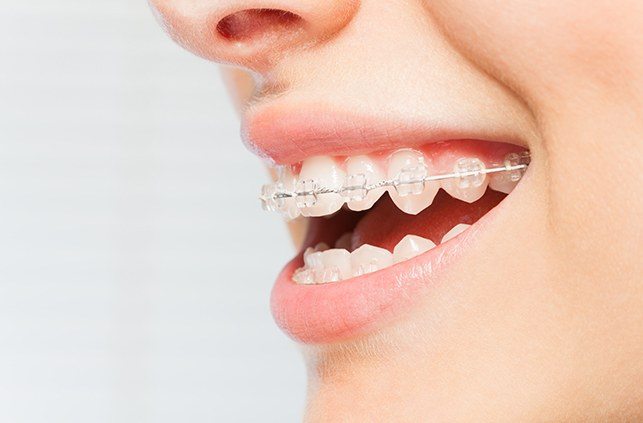 Closeup of smile with clear and ceramic braces