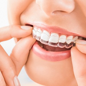 Closeup of woman putting on Invisalign in Southbridge