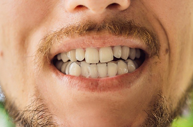 Man smiling at dentist during Invisalign consultation
