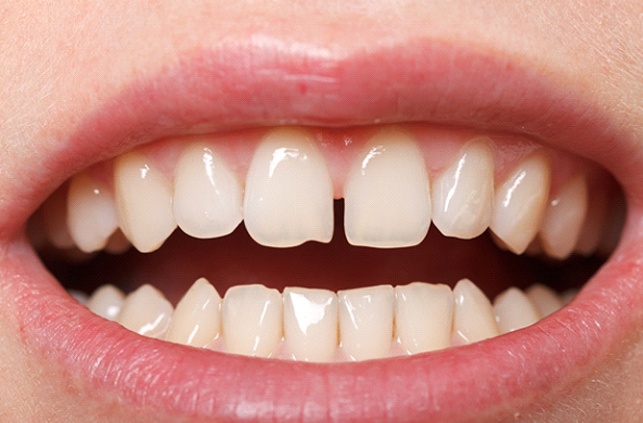 Diagram of gapped teeth in Worcester before orthodontics