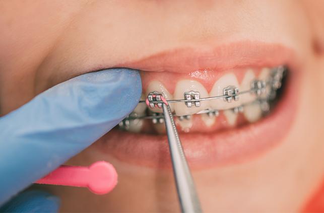 Orthodontist placing traditional braces