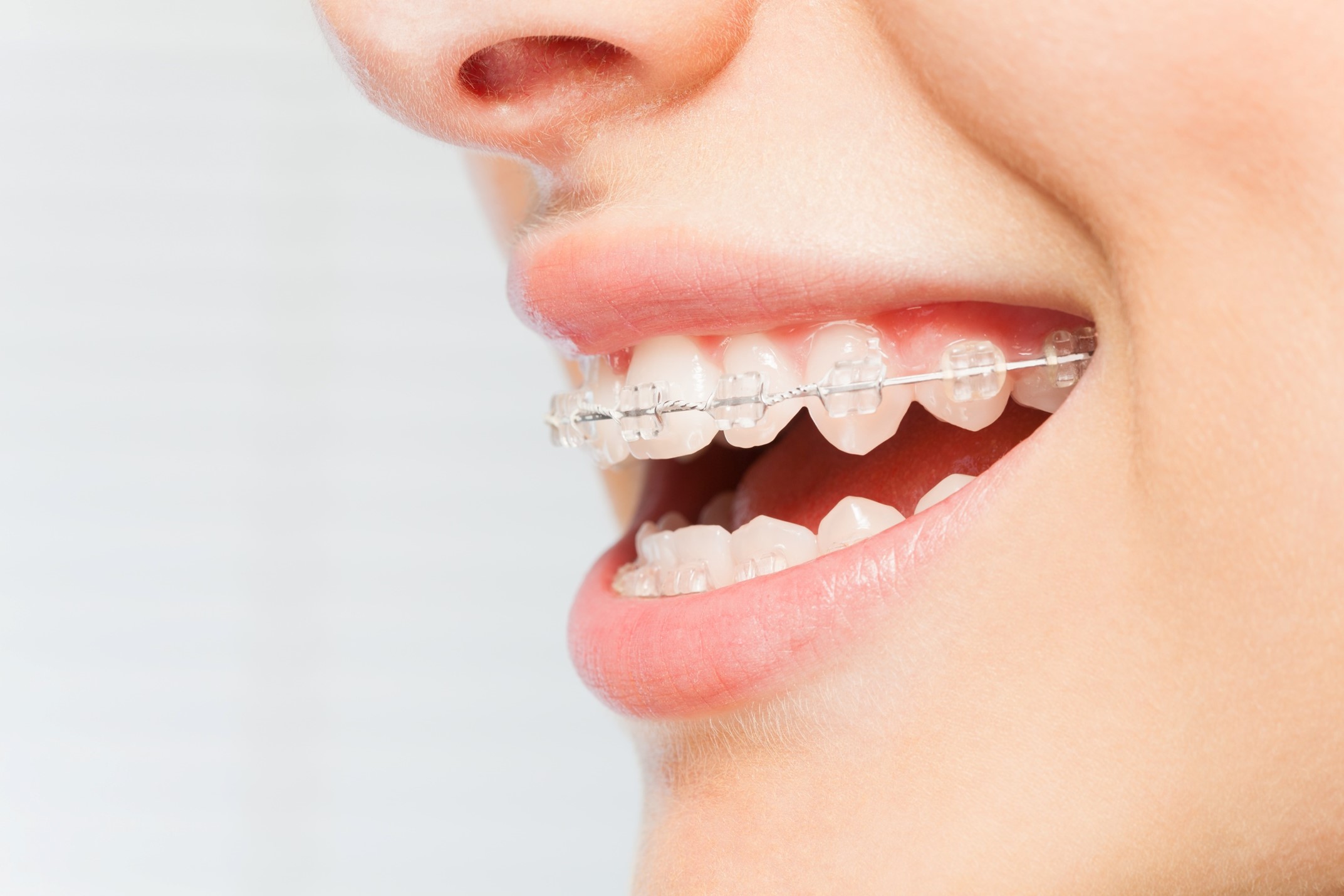 Invisible Braces: Fun Facts You Need to Know Today!