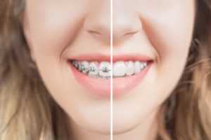 Closeup before and after braces in Southbridge